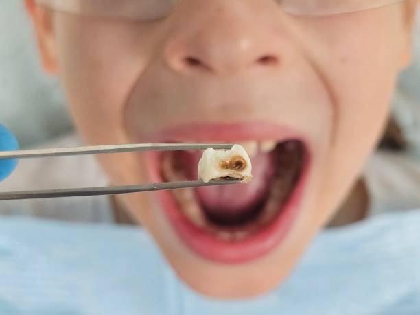 Best Emergency Dental Care for Trauma or Injury in Lake Ketchum, WA